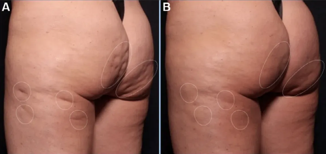 a before and after picture of a woman's butt
