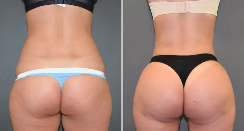 a woman's butt showing before and after butt lift