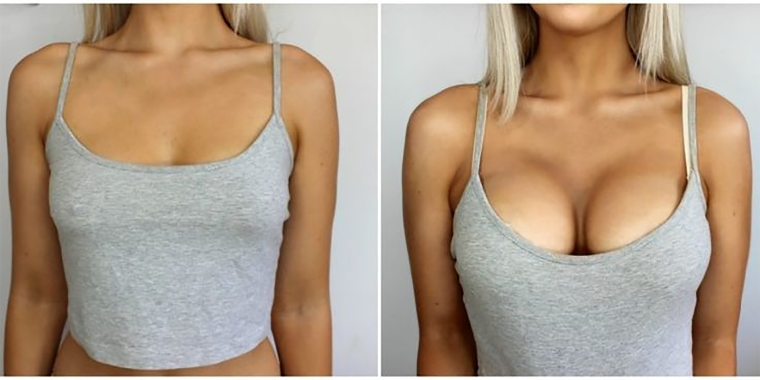 a woman's breast before and after breast surgery
