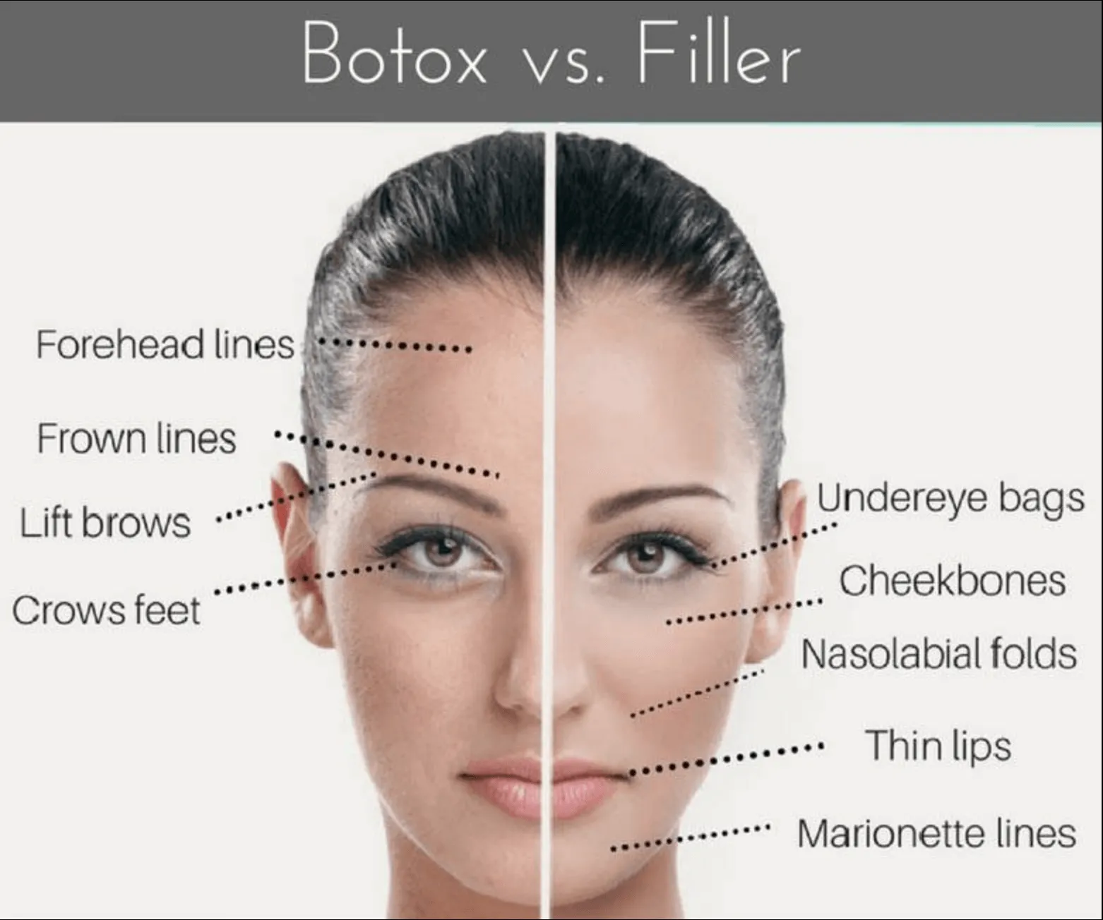a woman with botox and filler on her face