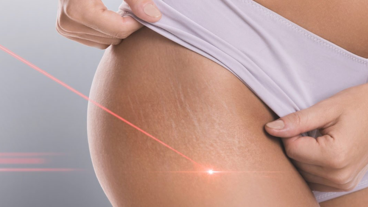 a woman's butt is shown with laser lines