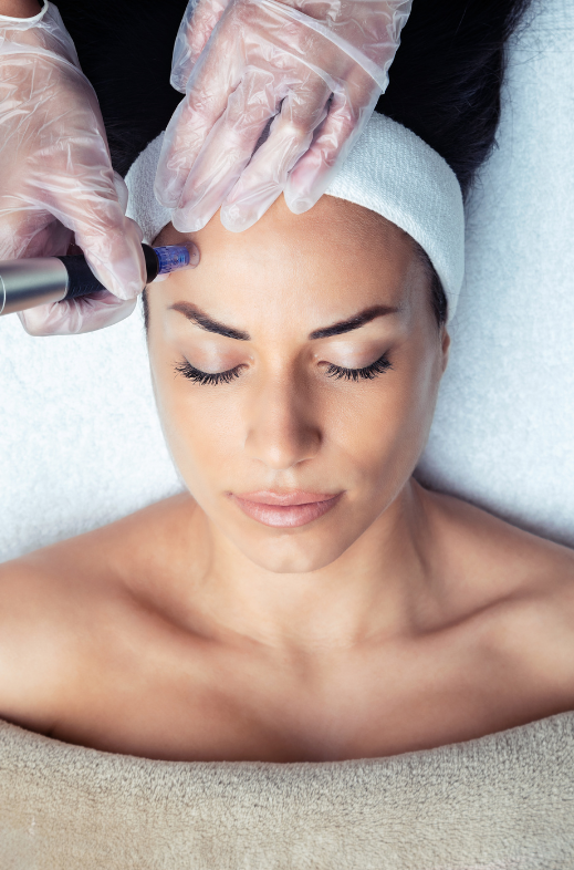 Microneedling Bala Cynwyd