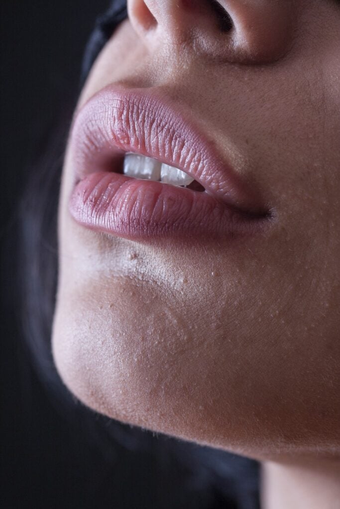 Dermal Fillers: what you need to know